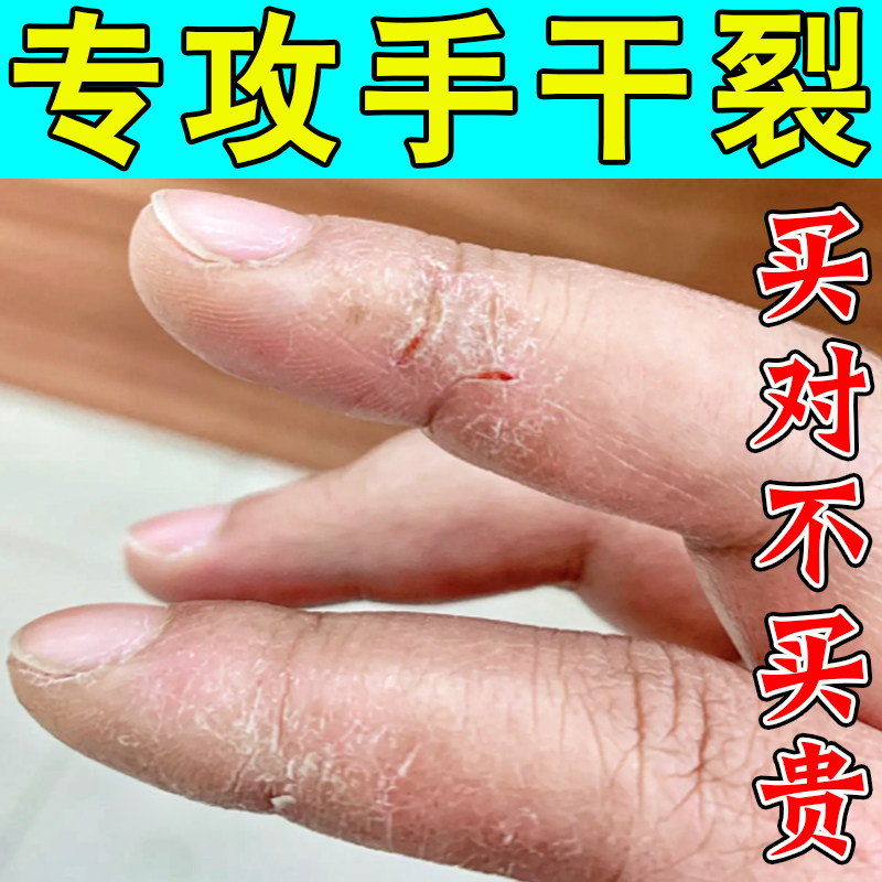 专攻手干裂手裂口子手脱皮蜕皮换季过敏粗糙干燥痒专用修复药乳膏