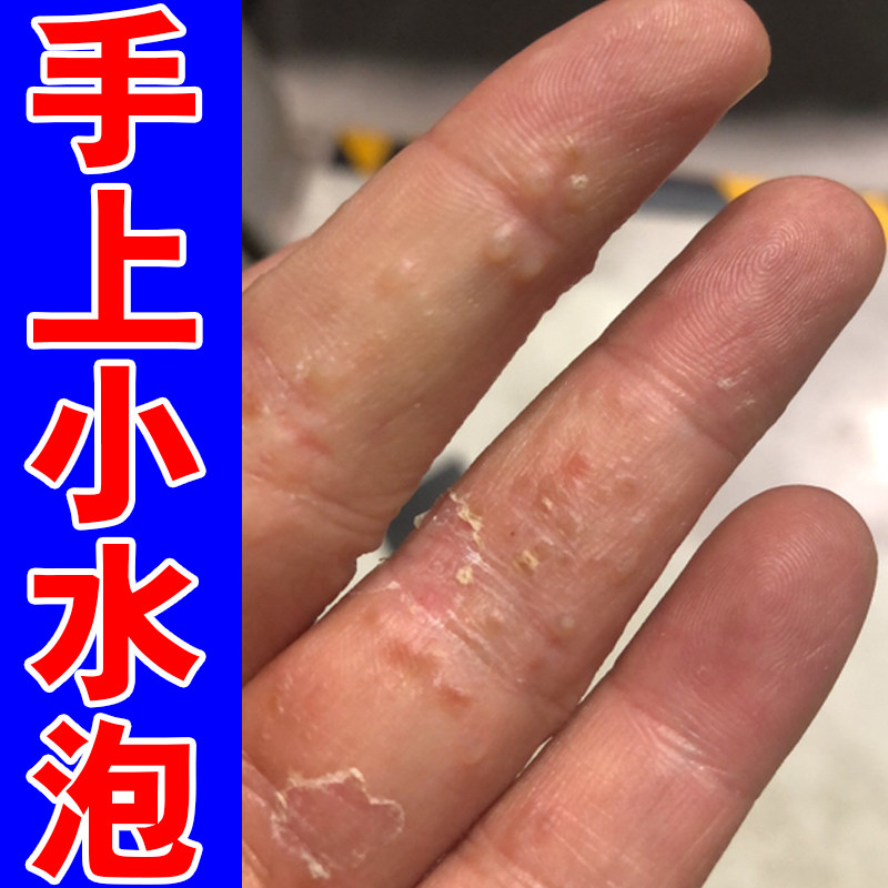 手指起痒药手上长小水泡真菌感染汗状手气手痒汗状手指痒手干燥药