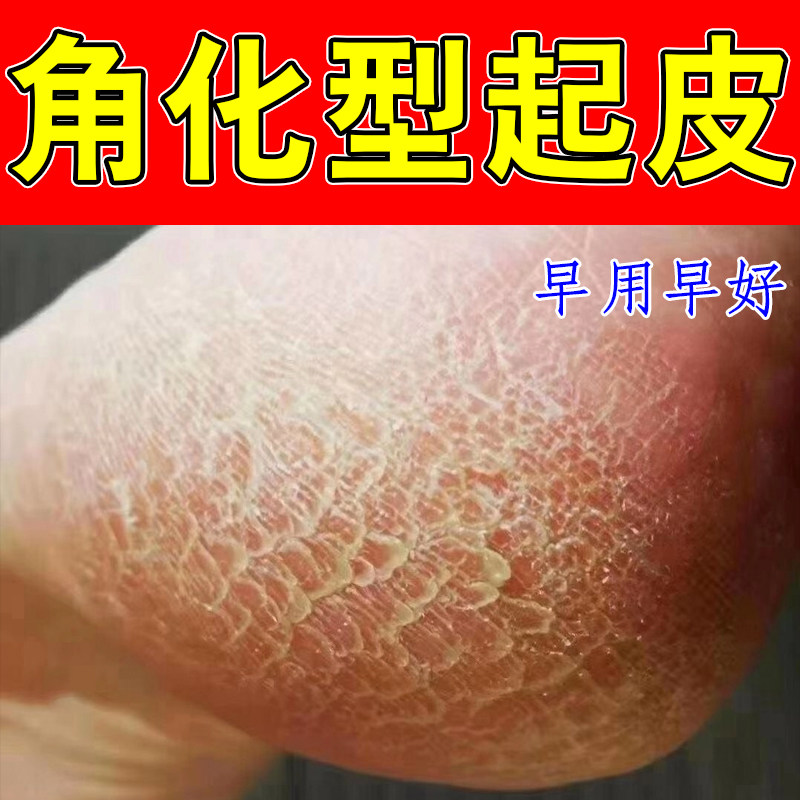 角化型起皮脚后跟粗糙硬皮掉屑脚皮麻麻赖赖辣手去死皮感染修护药