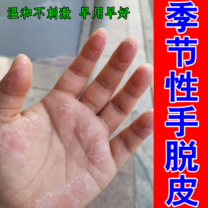 季节性手脱皮换季手大干皮掉屑粗糙过敏痒手上起小水泡抓挠痒起皮