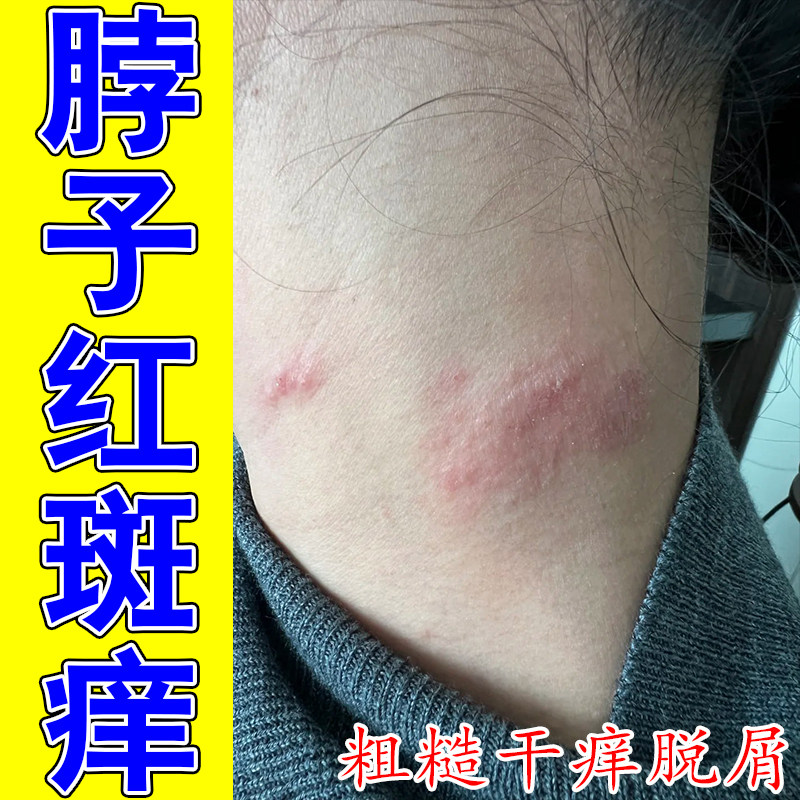 冶脖子上长红疙瘩发红皮肤过敏痒刺挠颈部红斑疙瘩起疙瘩子专用膏