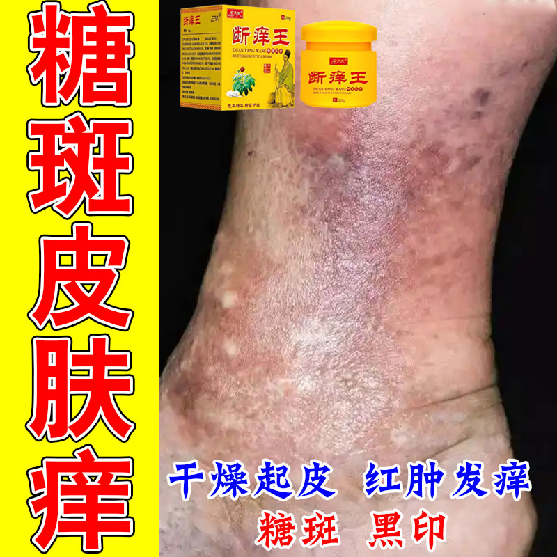 老年人糖斑皮肤痒干燥疙瘩痒脚上小腿皮肤褐色斑块糖化修护植物膏