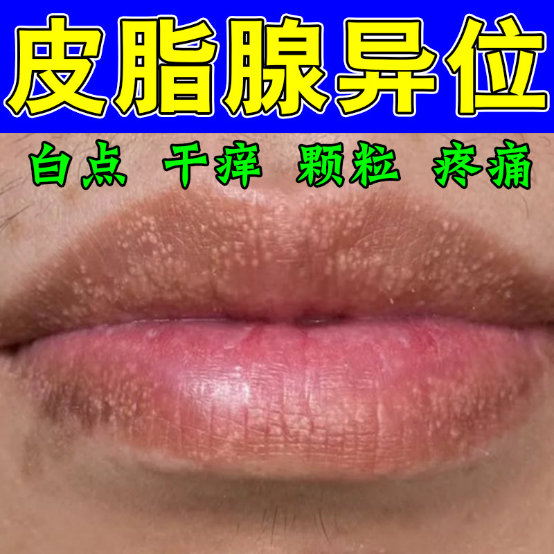 皮脂腺异位嘴角嘴唇白点增生干裂脱皮脂肪小颗粒干裂粗糙唇专用膏
