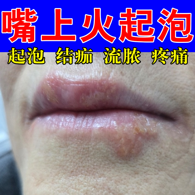 水泡长嘴上真菌泡嘴唇上火起泡肿痒唇上火起水泡染水泡肿疼草本膏