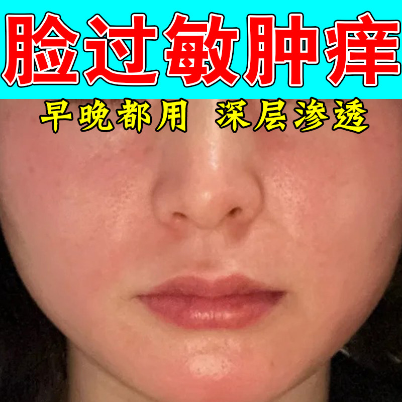 脸部过敏性红痒敏感泛红脱皮泛红紫外线过敏皮肤过敏干燥烫膏
