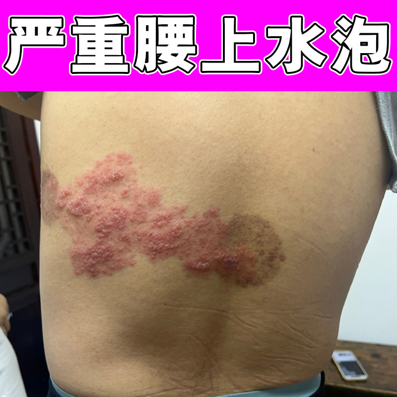 红泡带状盘腰上汗水疙瘩后遗症红肿刺痛热神经疼草本修护膏乳