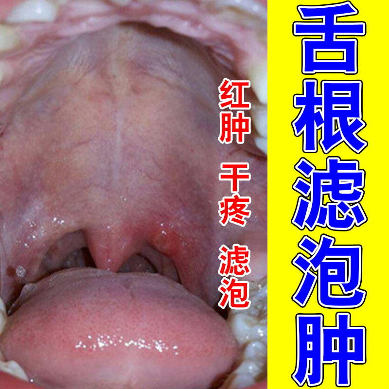 咽喉淋巴滤泡增生喉咙舌壁发红发热异物感草本修护咽喉喷剂