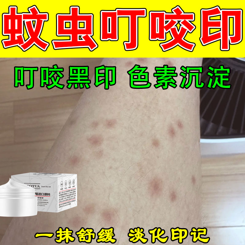 消蚊虫叮咬黑印暗沉蚊子咬淡化去黑色素印子沉淀修复保湿按摩膏