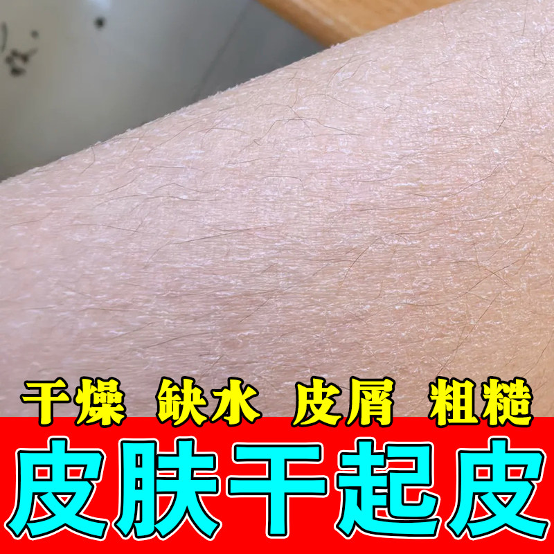 小腿干燥起皮屑痒腿上干燥粗糙皮屑白屑痒粗糙白皮修护保湿甘油