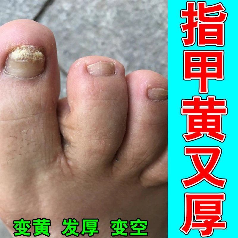 脚指甲发黄变厚变硬冶真菌性白甲脚指甲发黄变厚增厚修护草本膏乳