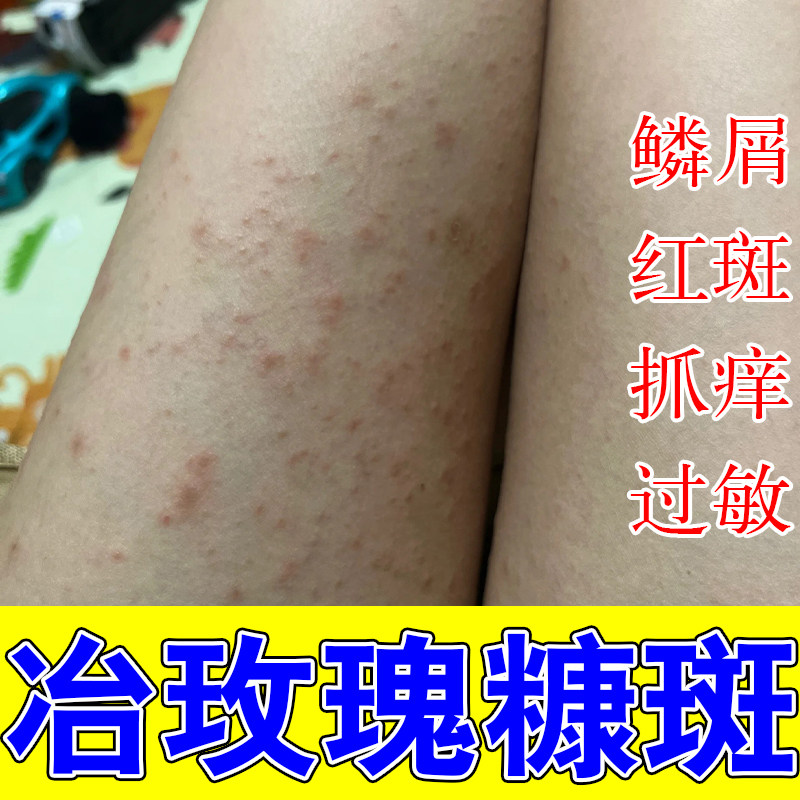 玫瑰红斑胳膊起红疙瘩红斑痒皮肤过敏痒粗糙起屑草本修护保湿乳膏