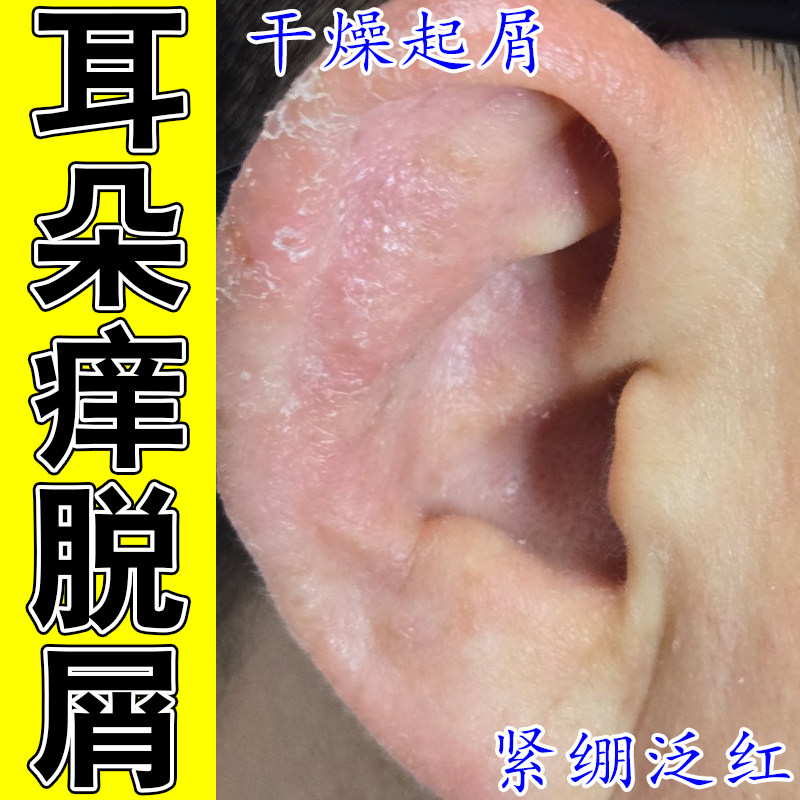 耳朵痒干燥起皮粗糙外耳道皮屑干燥起皮流脓结痂真菌起皮耳道痒膏