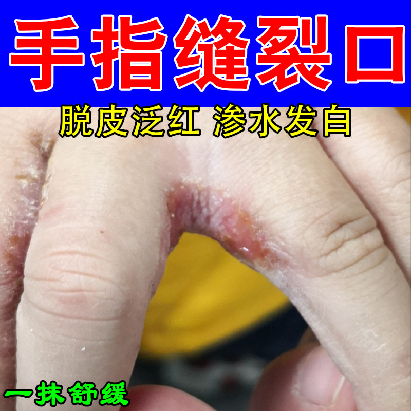 手指缝脱白皮渗水软膏手丫手指间经常碰水发痒开裂发红脱皮修护膏