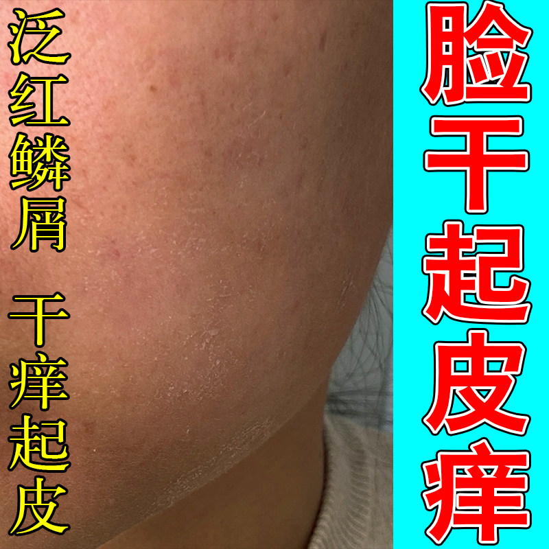 嘴角长脸部干燥起皮有碎屑泛红脱皮下巴周围起过敏干痒修护甘油