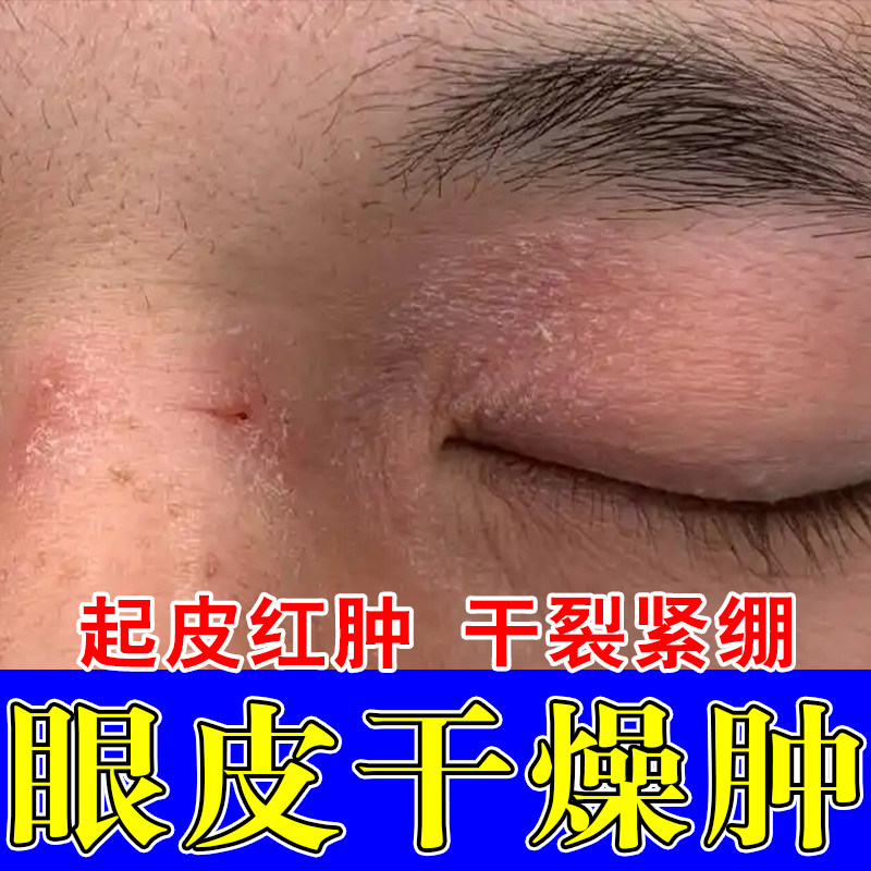 眼皮起皮干燥红肿过敏干燥神经性眼睛周围眼角痒起皮干痒结痂膏