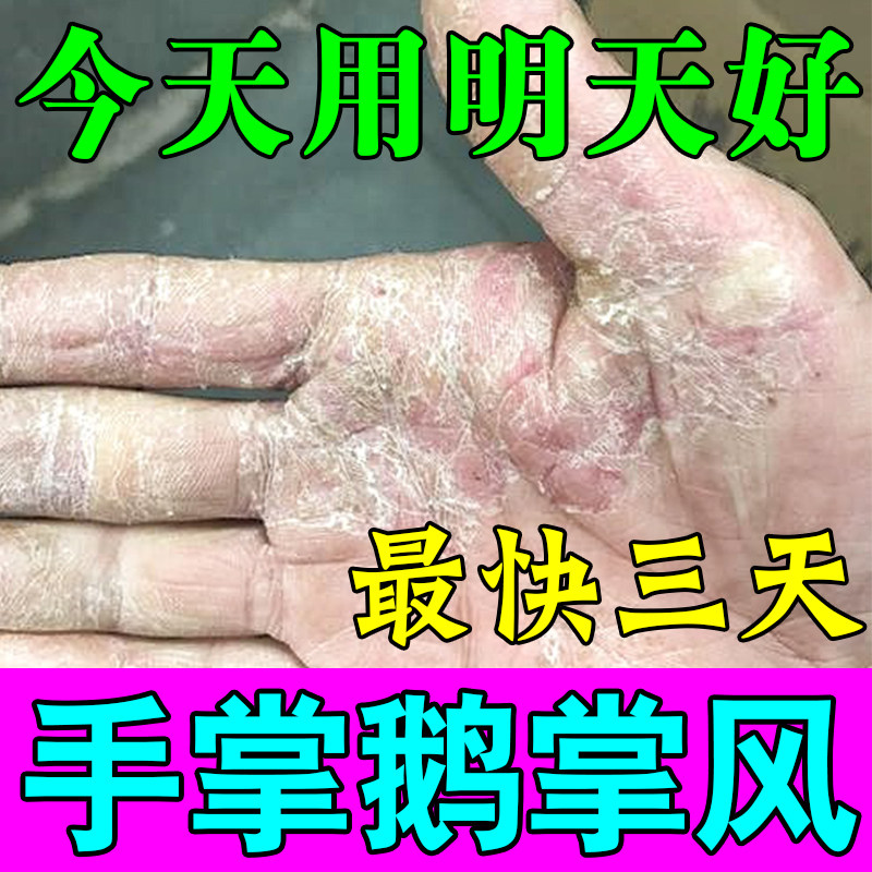 鹅掌风专用手癣膏止痒抑菌