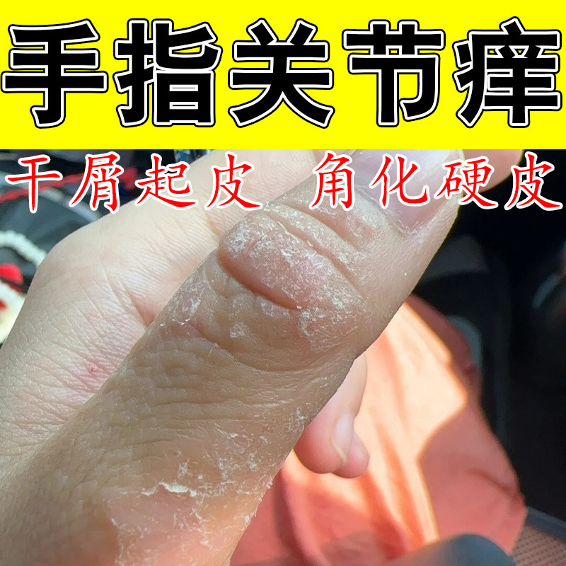 手指关节真菌手指关节长硬疙瘩伤粗糙脱皮手痒真菌硬块粗糙痒修膏