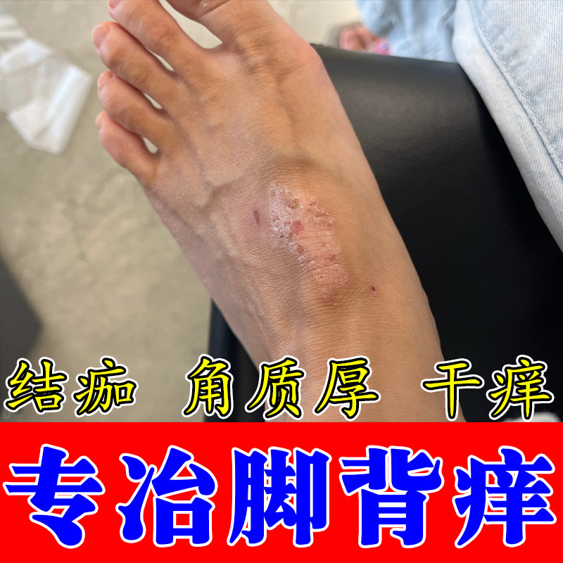 脚背面粗糙红斑疙瘩痒脚背痒干燥起皮脱皮痒起屑干燥修护保湿膏