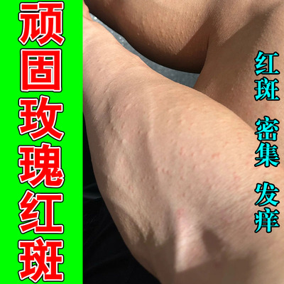 身上玫瑰红斑大面积肿痒刺挠发痒敏感起皮屑干燥不适皮肤膏