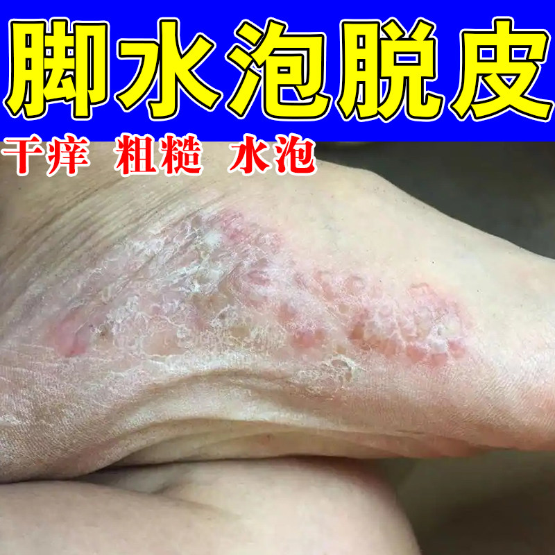 脚底长小水泡起皮干燥粗糙角质增厚真菌水泡足部修护草本软膏