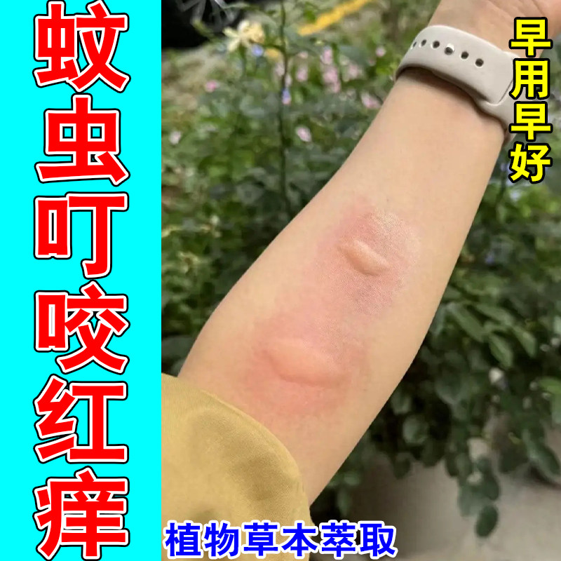 身上疙瘩痒蚊虫叮咬小虫咬皮肤过敏丘疙瘩红肿草本专用修护喷剂