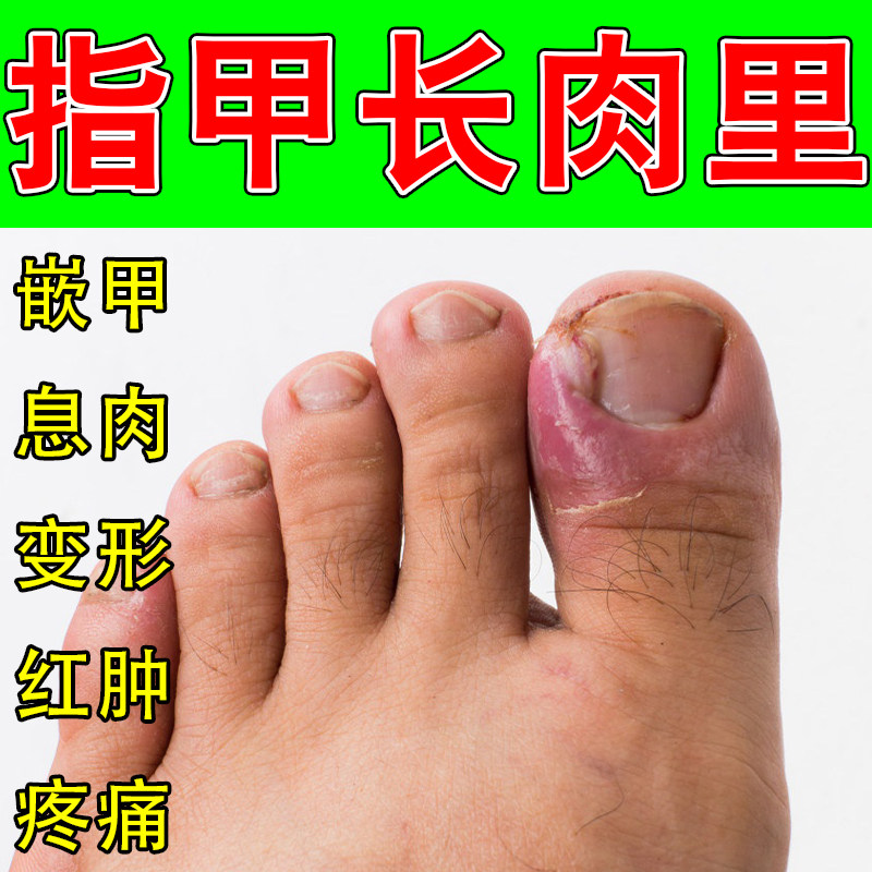 甲沟嵌甲红肿软甲膏指甲息肉肿大脱皮草本修护舒缓疼痛专用乳膏