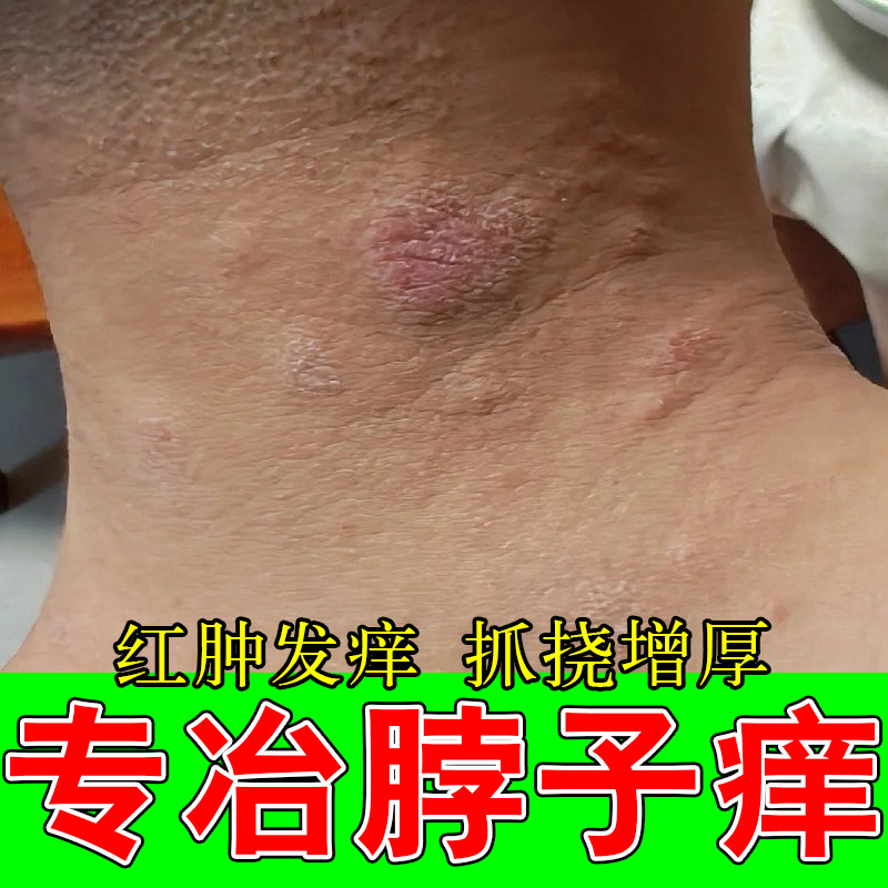 脖子上长红斑皮肤干燥粗糙发痒草本乳膏颈部干燥刺挠红肿皮过敏膏