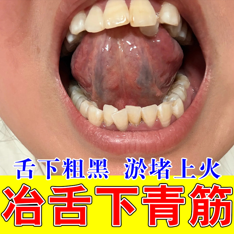 舌头底黑紫粗血管堵塞舌根舌下青筋粗大红肿疼痛草本修护喷剂