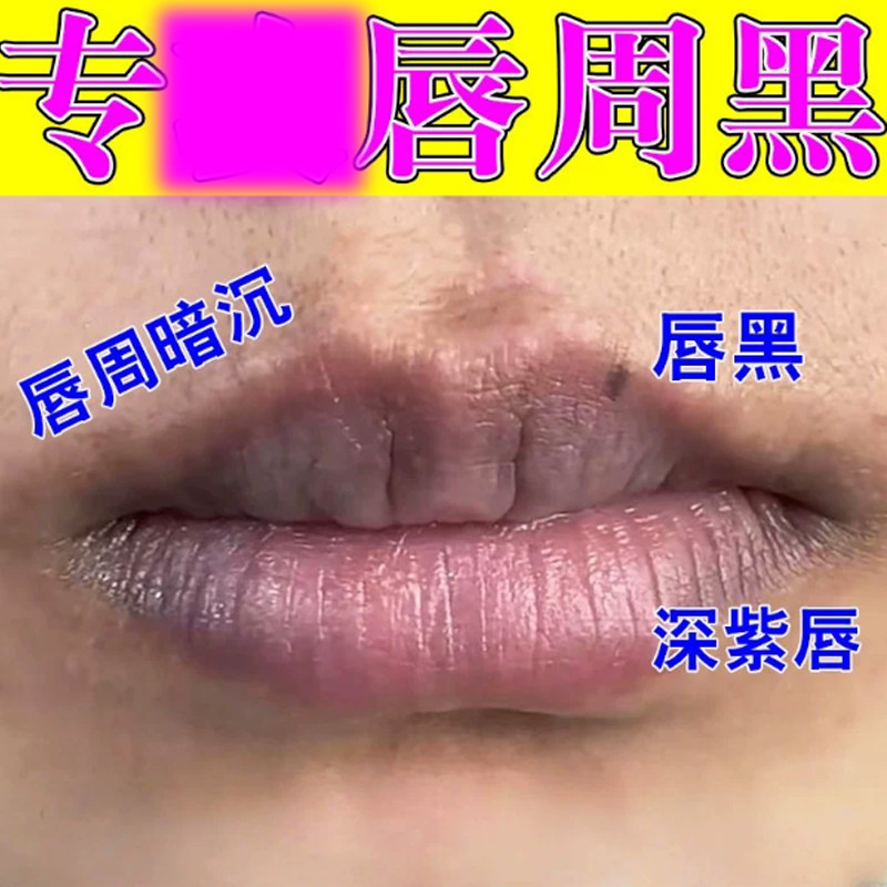 嘴唇发黑发紫去除嘴巴周边暗沉改善唇周黑去唇角边黑素淡化唇黑
