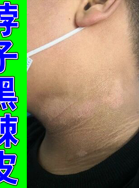胳膊肘黑死皮手肘干燥粗糙脖子黑色素沉淀关节黑保湿修护膏乳