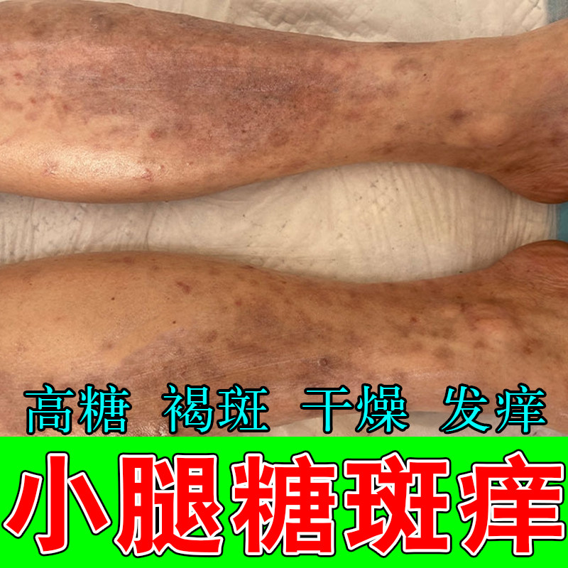 老年人糖斑皮肤痒干燥疙瘩痒脚上小腿皮肤褐色斑大块糖化修护膏