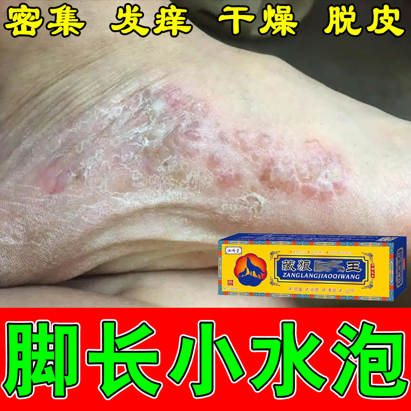 脚底长小水泡起皮干燥粗糙角质增厚真菌水泡足部修护草本软膏