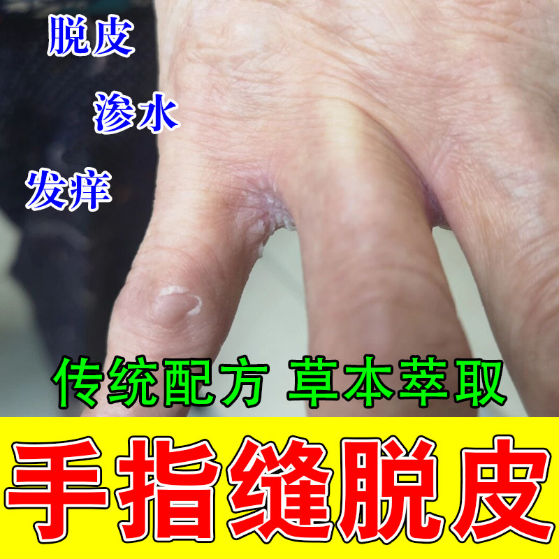手指缝脱白皮渗水红痒膏药经常碰皮肤消毒护理（消）