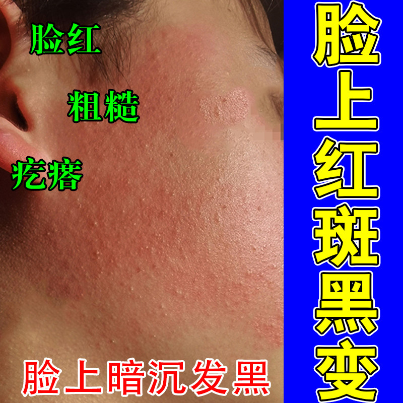 冶脸毛囊红斑黑变粗糙疙瘩暗沉脸变泛红黑变粗糙暗沉修护草本膏