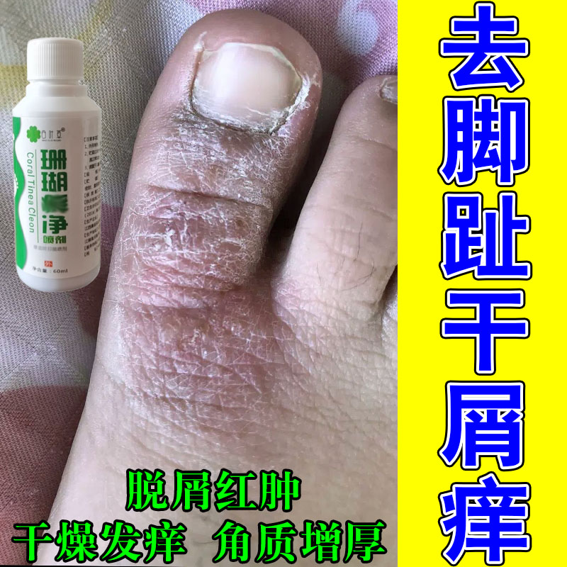 脚趾关节上长治脚趾头痒脚背痒干燥起皮红斑皮刺挠修护保湿膏