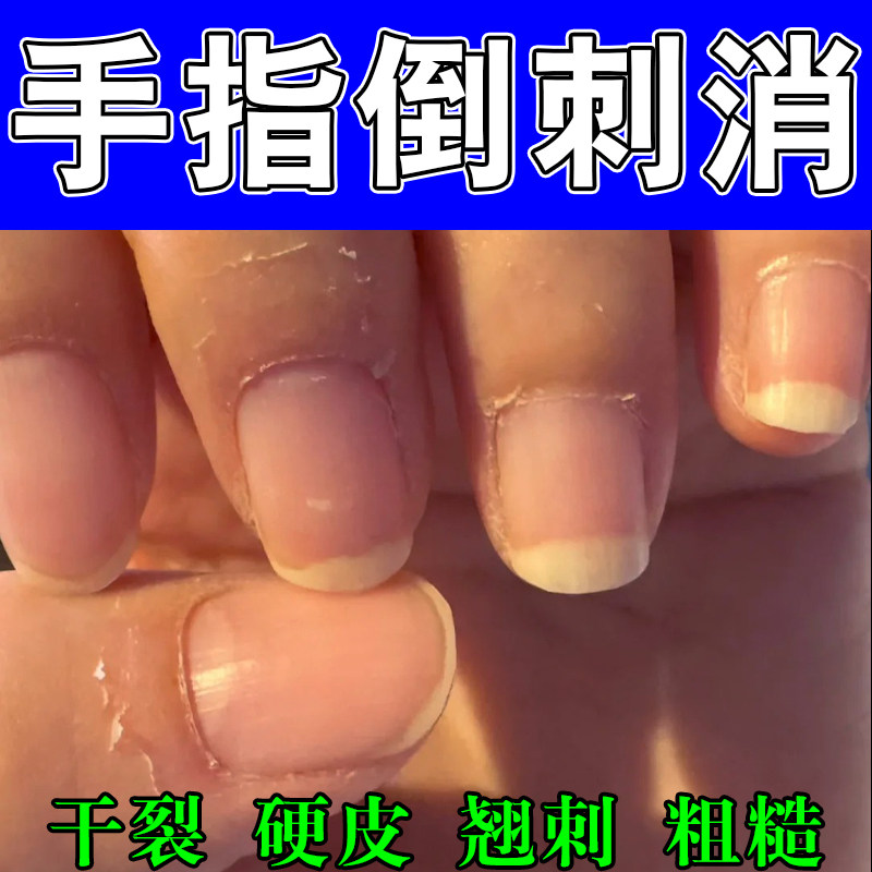 手指起倒刺手足脱皮肉刺手指头起皮肉刺出血指甲边缘修护保湿膏