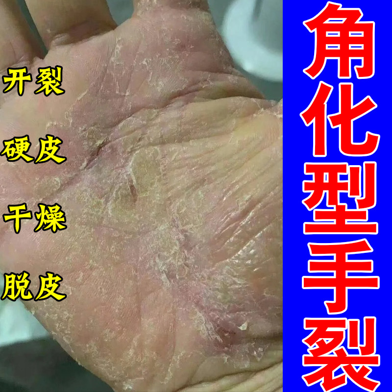 严重手干裂角化型起皮干燥粗糙手心手指开裂粗糙干燥掉皮修护软膏