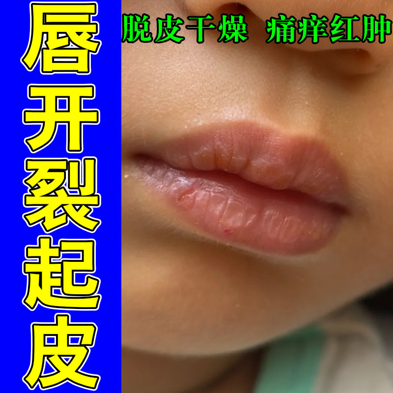 嘴角干燥起皮嘴巴干裂脱皮上火嘴皮肤消毒护理（消）