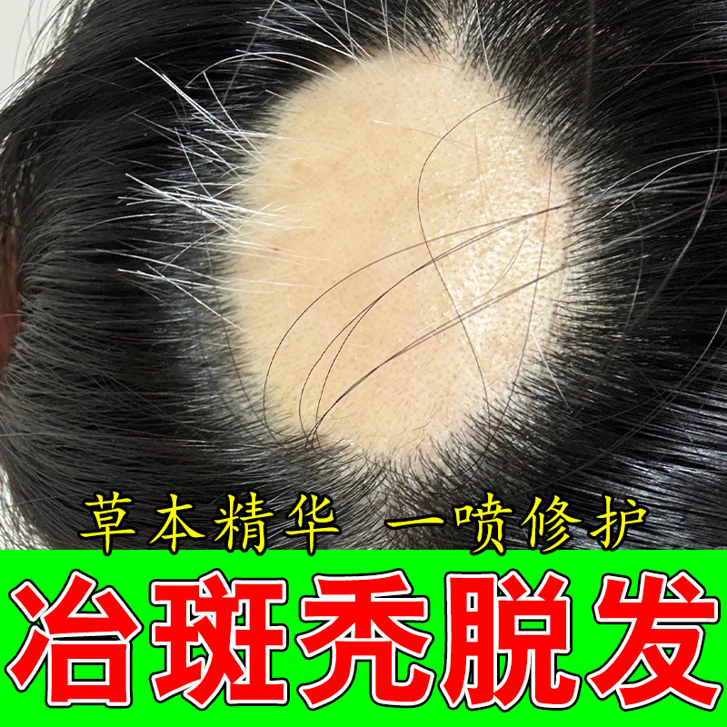冶头顶斑秃大面积脱发头顶后脑勺秃顶没头发草本修复头发喷剂