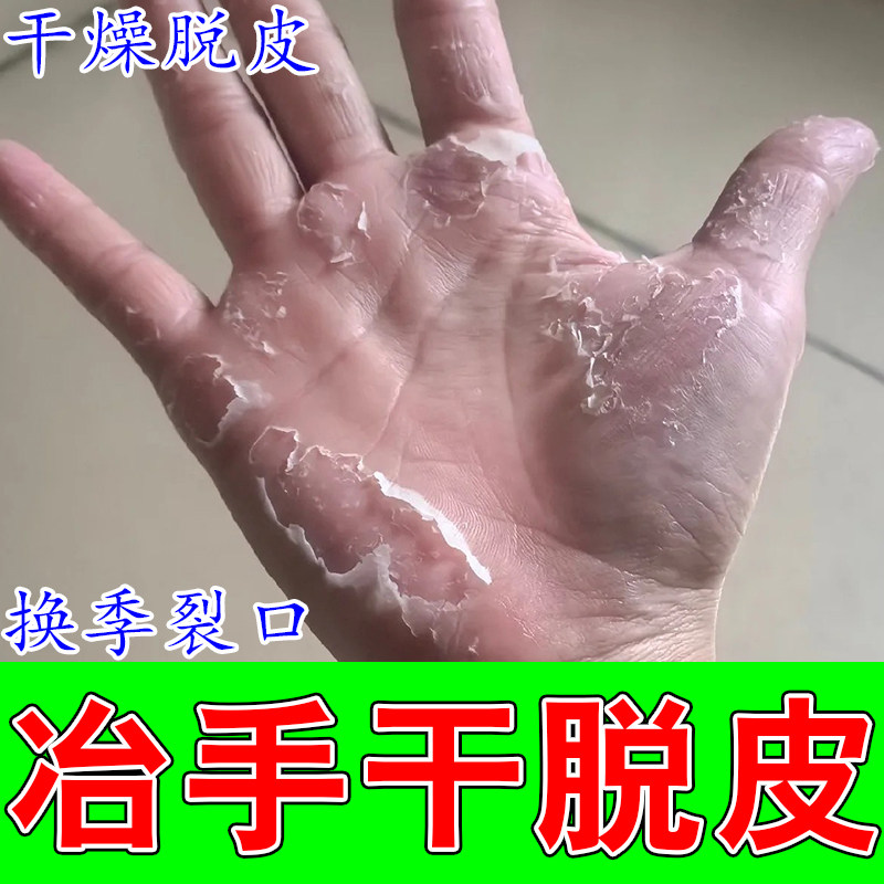 手指脱皮指尖脱皮干裂真菌严重蜕皮干燥起皮干燥起皮手指膏