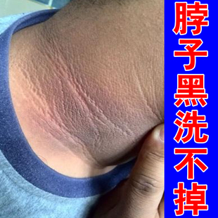 去脖子黑色素黑沉淀症黑棘皮膏颈死皮儿童成人皮肤