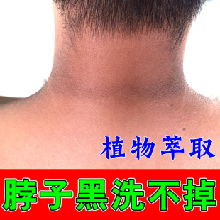 脖子皮肤洗不干脖子黑黑的黑棘皮症腋下色素沉淀按摩膏