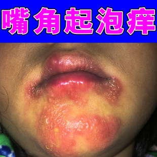 小孩嘴周红防止舔嘴唇羊胡子膏嘴巴一圈红干裂红肿上火专用