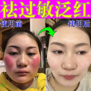 脸部过敏皮肤修复过敏痒红肿去脸上的红血丝修复角质层去除高原红