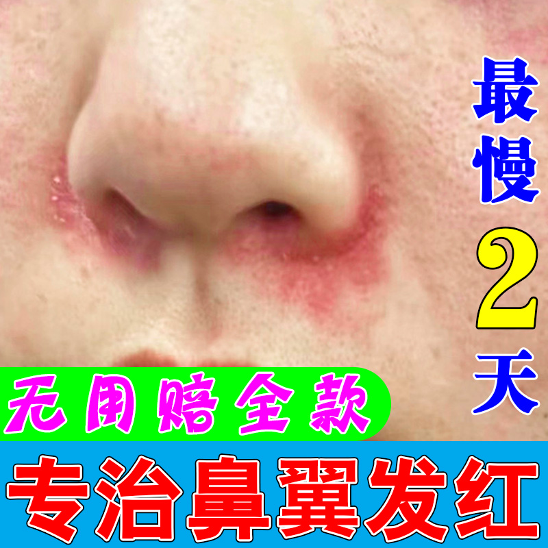 鼻子两侧泛红脱皮痒面部