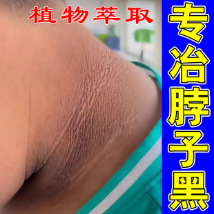 脖子黑棘皮症色素皮肤沉淀颈部脖子黑洗不干净专用霜