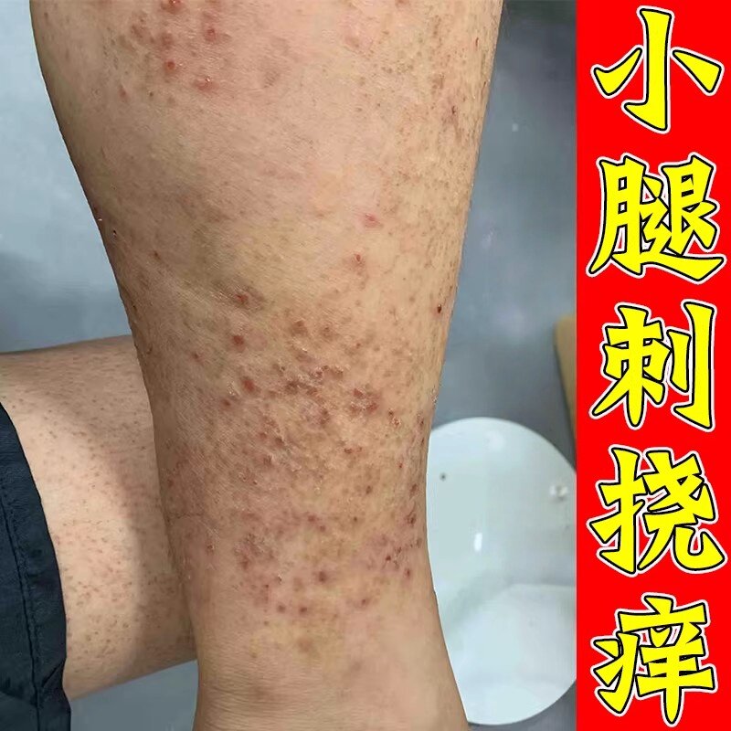 小腿皮肤痒干燥起皮掉皮屑腿部长小红点起红疙瘩剧烈痒专用软膏
