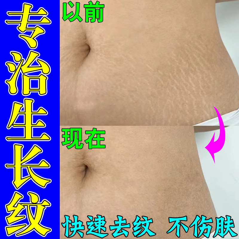 生长纹消除大腿学生去肥胖纹修复霜去除腹部臀部大腿膨胀纹专用膏