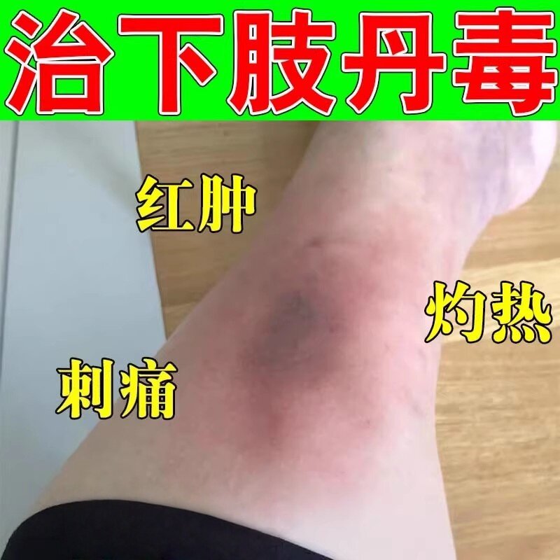 丹毒的腿脚湿热畏寒肿胀引起皮肤红肿疼痛灼热流火修复乳膏