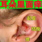 耳朵真菌感染外耳道皮屑干燥起皮流脓结痂霉菌性耳道炎专用